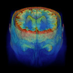 Image created by stacking DICOM MRI images.       NYTCREDIT: Zach Wise for The New York Times
